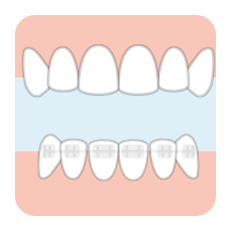 上だけ裏側装置