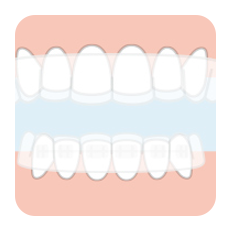 マウスピース型矯正装置